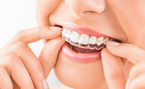 dental braces tx, person putting on clear braces