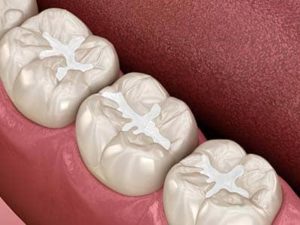 examples of Dental Sealants