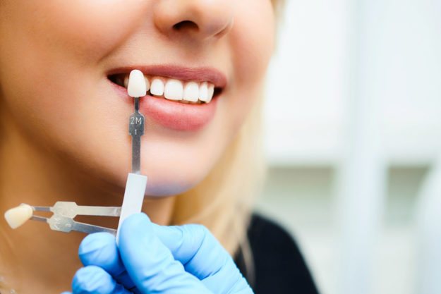 can veneers fall off veneer next to patient smile who wonders can veneers fall off