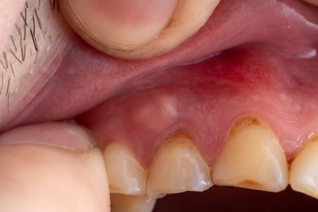 abscessed-tooth abscessed tooth