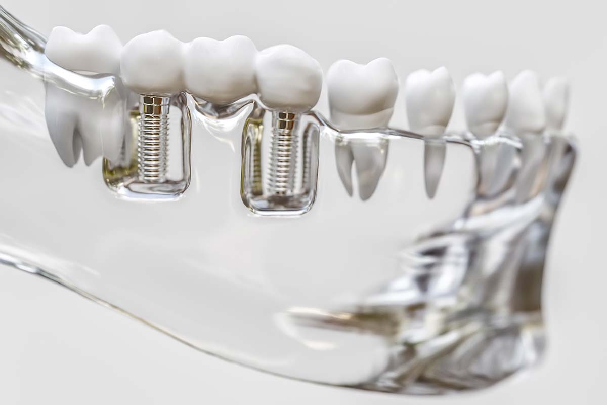 dental-implants dental implants
