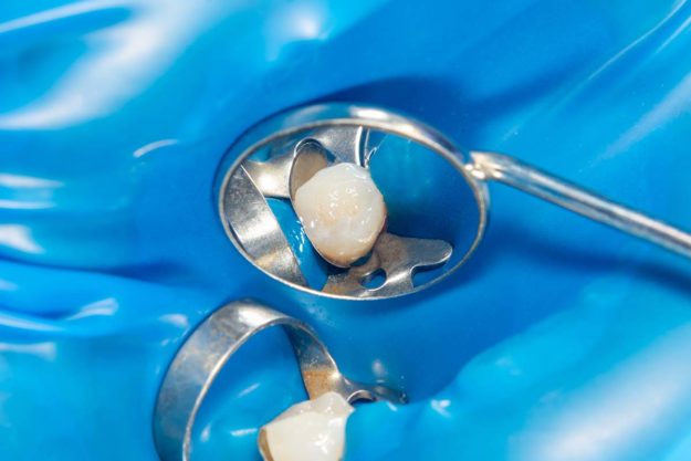 dental-sealants how dental sealants work