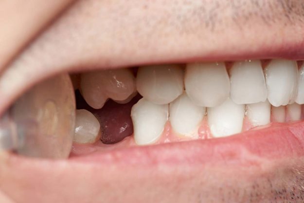 replacement-teeth replacement teeth options