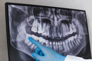 dental chart showing impacted teeth