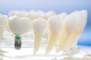 model of dental implants