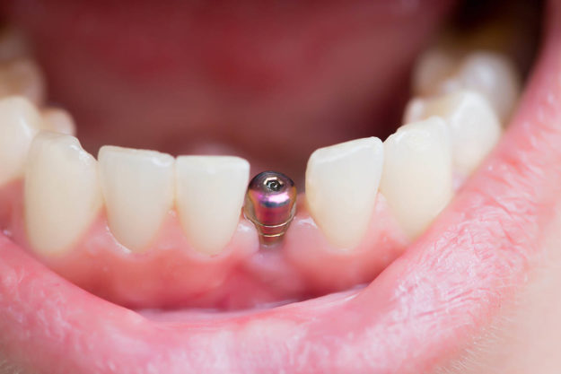 What is a Single Tooth Implant (1) example of a single tooth implant
