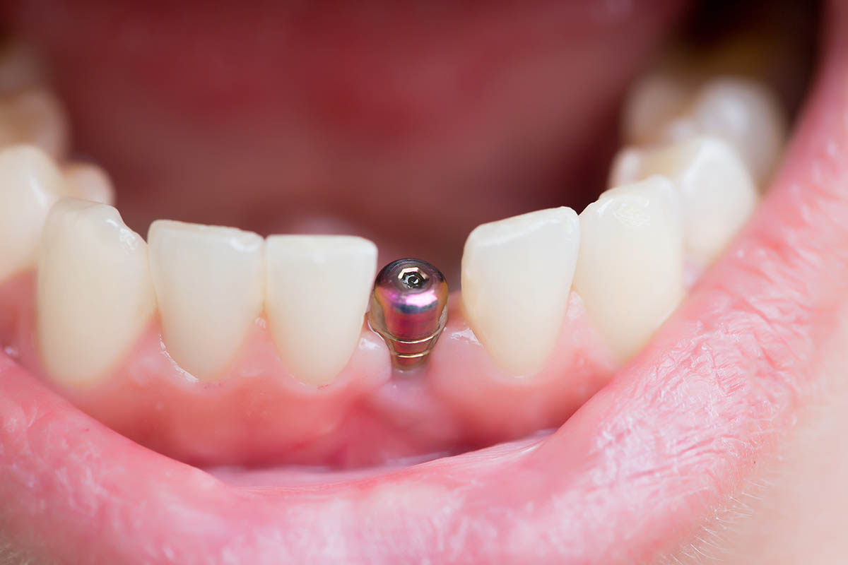 What is a Single Tooth Implant (1) example of a single tooth implant