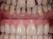 before and after of dental veneers