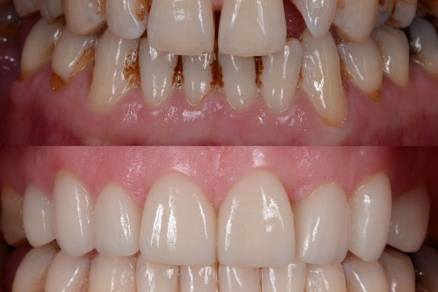 5 Benefits of Dental Veneers before and after of dental veneers