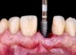 example of dental implants