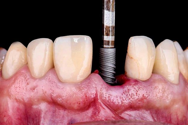 How Do Dental Implants Work example of dental implants